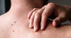 1766237513_skin-cancer